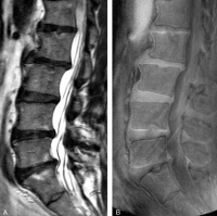 沒有腰痛人士的磁力共振影像。圖左為傳統的T2W磁力共振影像，顯示參與者有多節腰椎退化及椎體變異。圖右為UTE磁力共振影像，顯示參與者沒有UTE 椎間盤病徵（UDS）。